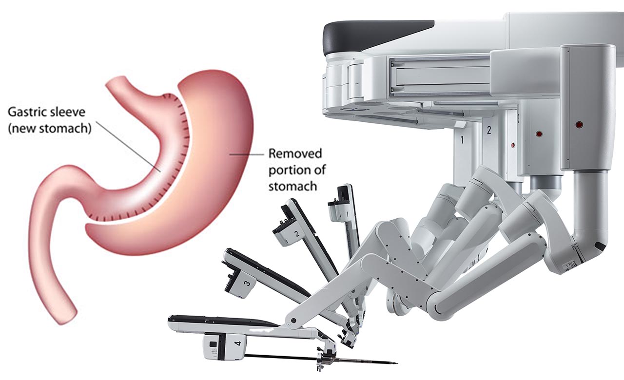 Robotic-Assisted Vertical Sleeve Gastrectomy